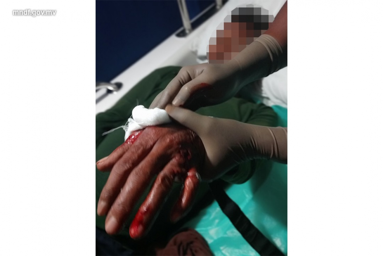 މޫދަށް އެރިއުޅުނު ފަތުރުވެރިއަކަށް މިޔަރެއް ހަމަލާދީ، އެއް ފައި ބުރިކޮށްލަން ޖެހިއްޖެ