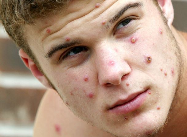 މަންކީޕޮކްސްއަށް ދިވެހިން ކިޔާނީ "މަކުނުވިދުރި"