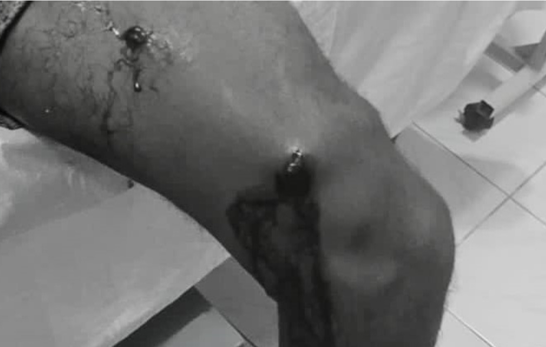 ފީނަންއުޅުނު ޒުވާނެއްގެ ފަޔަށް ތޮޅިއެއްގެ ތުންގަނޑު ހެރި ޒަހަމްވެއްޖެ