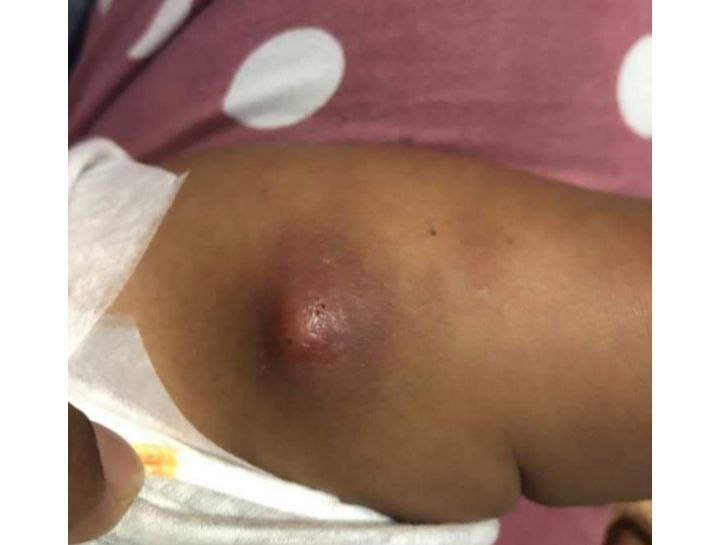 ވެކްސިން ޖެހިގޮތުން ދެމަހުގެ ކުއްޖެއްގެ ފައި އިންފެކްޓްވި މައްސަލައެއް