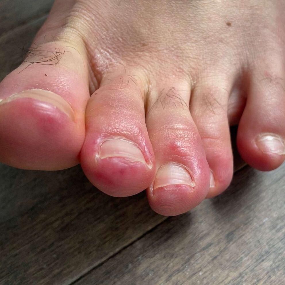 ކޯވިޑް-19: ބައްޔާ ގުޅުންހުރި ހަމުގެ މައްސަލައެއް ފާހަގަވެއްޖެ