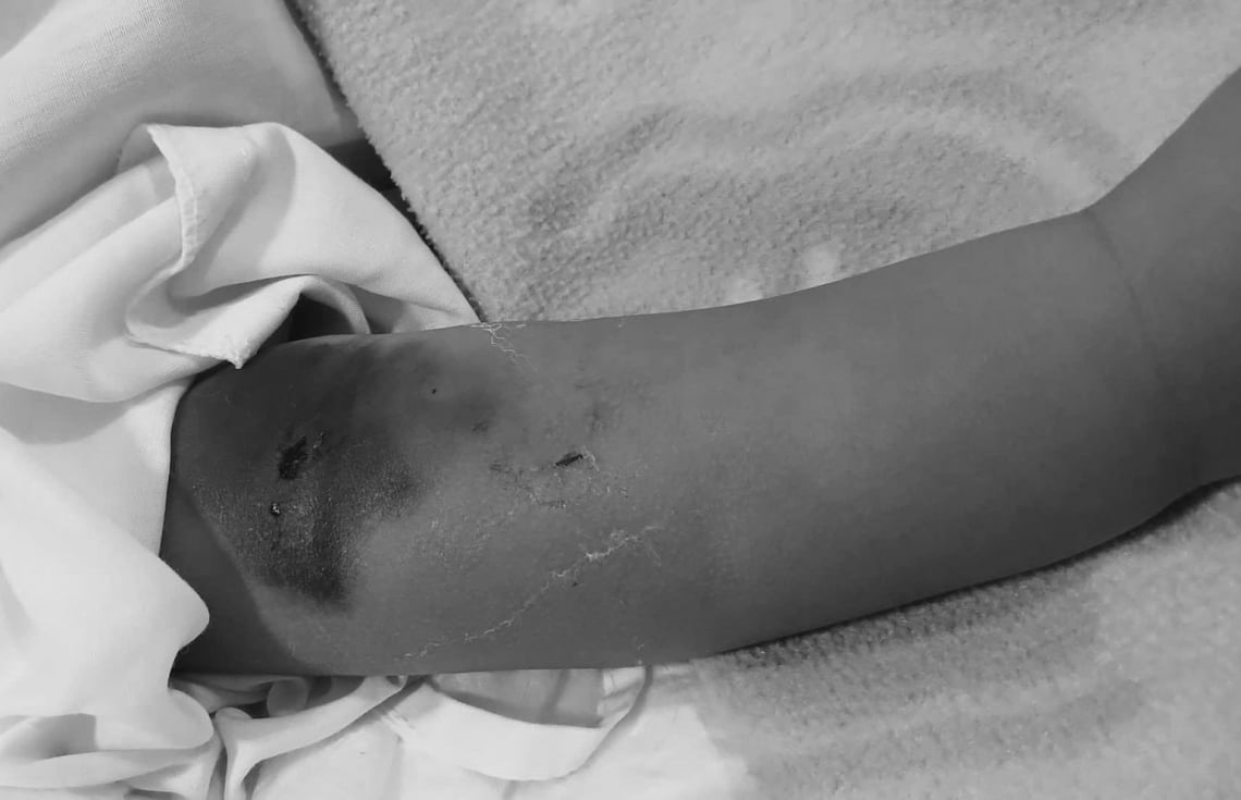 ކުޅުދުއްފުށީ ހޮސްޕިޓަލުގެ އިހުމާލުން ކުޑަކުއްޖެއްގެ ހާލު ގޯސްވި މައްސަލަ ބަލަނީ