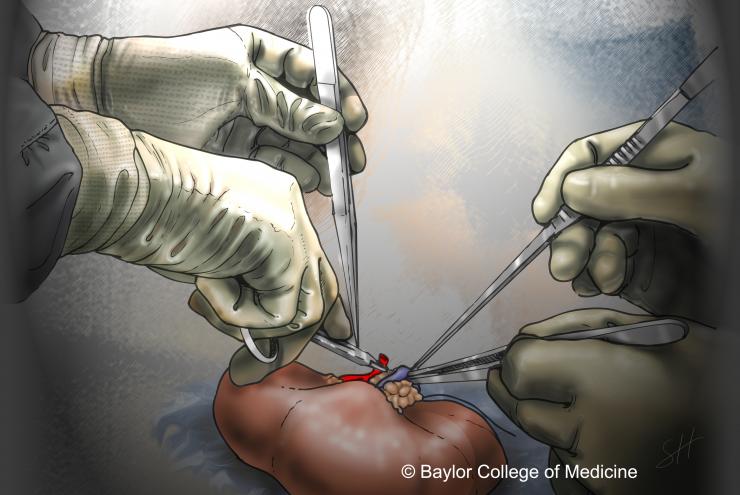 ކިޑްނީ ޓްރާންސްޕްލާންޓަށްފަހު ބަލިވެއިނުމުގެ ފުރުސަތުކުޑަތަ؟